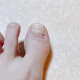 유케어 YOU CARE 문제성 손발톱케어_럭키풋 — 5점을 준 리뷰어가 2022년 10월 올린 사용 사진