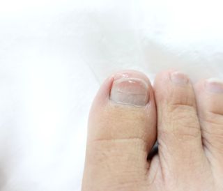 유케어 YOU CARE 문제성 손발톱케어_럭키풋 — 5점을 준 리뷰어가 2022년 10월 올린 사용 사진