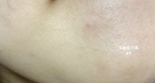 세뚜아(Cettua) 세뚜아 스팟 클리어 듀얼 패치 Cettua Spot Clear Dual Patch — 5점을 준 리뷰어가 2023년 8월 올린 사용 사진