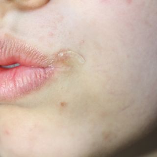 히루스카 포스트아크네 클리어 — 2점을 준 리뷰어가 2021년 2월 올린 사용 사진