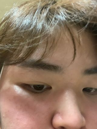 히루스카 포스트아크네 클리어 — 2.5점을 준 리뷰어가 2021년 1월 올린 사용 사진