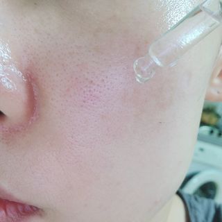 퍼퓸홀릭 [보툴리늄 원액] 7일의 변화 메디-보툴리늄 — 5점을 준 리뷰어가 2021년 9월 올린 사용 사진