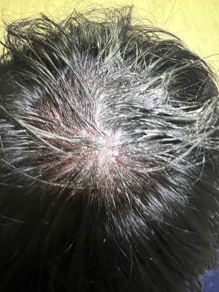 닥터시드 티트리 앤 라임 비건 지성케어 쿨 탈모 두피 워터 스케일러 — 5점을 준 리뷰어가 2024년 4월 올린 사용 사진