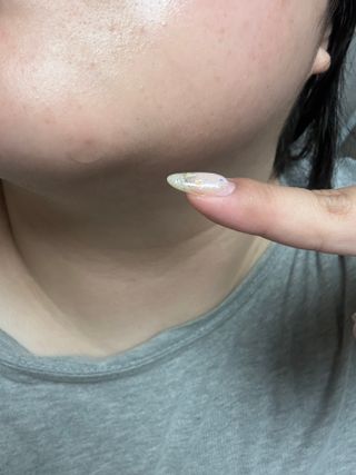 세뚜아(Cettua) 세뚜아 스팟 클리어 듀얼 패치 Cettua Spot Clear Dual Patch — 5점을 준 리뷰어가 2023년 8월 올린 사용 사진
