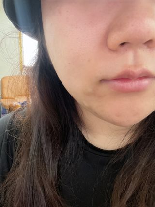 올리브영 엘라밴드 하이드로 도트 스팟패치 12mm, 티트리 — 5점을 준 리뷰어가 2022년 9월 올린 사용 사진