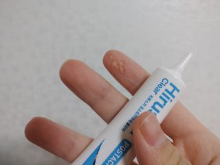히루스카 포스트아크네 클리어 — 4점을 준 리뷰어가 2021년 2월 올린 사용 사진