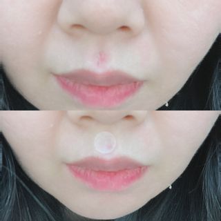 에버렐 아크네 클리어 패치 오리지널(40매) + XL(8매) 1세트, 각 1개씩 — 5점을 준 리뷰어가 2022년 5월 올린 사용 사진