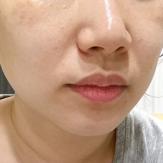 3M 넥스케어 블레미쉬 여드름패치 릴리프 111매(짜기 전 케어) +알코올스왑 증정 — 5점을 준 리뷰어가 2024년 5월 올린 사용 사진
