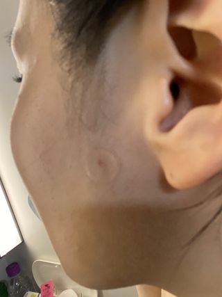 세뚜아(Cettua) 세뚜아 스팟 클리어 듀얼 패치 Cettua Spot Clear Dual Patch — 5점을 준 리뷰어가 2023년 6월 올린 사용 사진