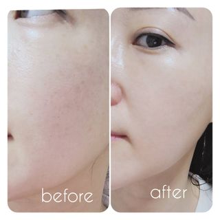 메디필 레드 락토 콜라겐 필링패드 — 5점을 준 리뷰어가 2021년 3월 올린 사용 사진