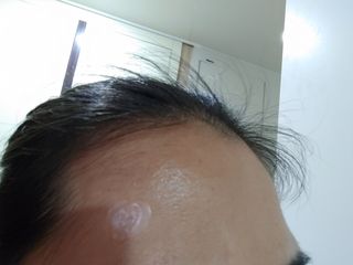 마이디플러스 트러블 릴리프 케어 마이크로 패치 1박스 2매 — 5점을 준 리뷰어가 2021년 11월 올린 사용 사진