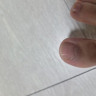 유케어 YOU CARE 문제성 손발톱케어_럭키풋 — 5점을 준 리뷰어가 2022년 10월 올린 사용 사진