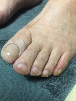 유케어 YOU CARE 문제성 손발톱케어_럭키풋 — 5점을 준 리뷰어가 2022년 10월 올린 사용 사진