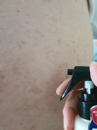 [후르디아] 등드름 잡는 바디 미스트 2개 세트 — 4.5점을 준 리뷰어가 2021년 6월 올린 사용 사진
