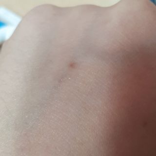 히루스카 포스트아크네 클리어 — 5점을 준 리뷰어가 2021년 3월 올린 사용 사진