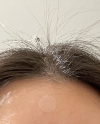 소담스퀘어 상암 디팩코퍼레이션 놀라아워 비건 하이드로콜로이드 클리어 패치 — 5점을 준 리뷰어가 2022년 12월 올린 사용 사진