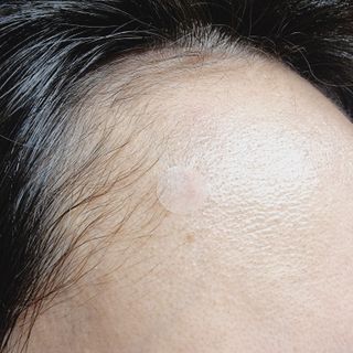 세뚜아(Cettua) 세뚜아 스팟 클리어 듀얼 패치 Cettua Spot Clear Dual Patch — 5점을 준 리뷰어가 2023년 7월 올린 사용 사진