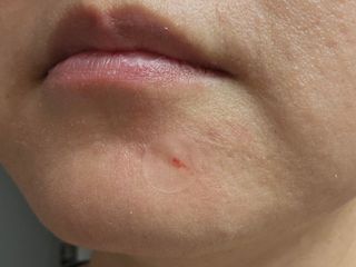 3M 넥스케어 블레미쉬 여드름패치 릴리프 111매(짜기 전 케어) +알코올스왑 증정 — 5점을 준 리뷰어가 2024년 6월 올린 사용 사진