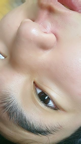 에버렐 아크네 클리어 패치 오리지널(40매) + XL(8매) 1세트, 각 1개씩 — 5점을 준 리뷰어가 2022년 5월 올린 사용 사진