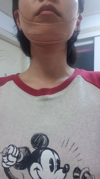 아이디플라코스메틱 아이디 페이스핏 마이너스 밴드 v2 — 4점을 준 리뷰어가 2021년 5월 올린 사용 사진