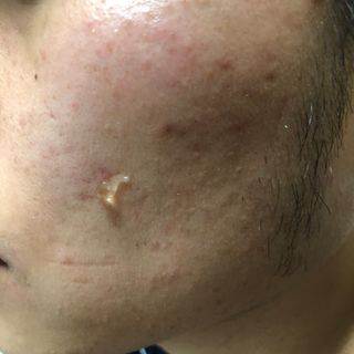 히루스카 포스트아크네 클리어 — 4.5점을 준 리뷰어가 2021년 2월 올린 사용 사진