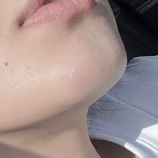소담스퀘어 상암 디팩코퍼레이션 놀라아워 비건 하이드로콜로이드 클리어 패치 — 5점을 준 리뷰어가 2023년 1월 올린 사용 사진