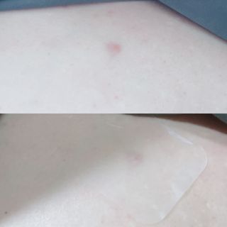 에버렐 아크네 클리어 패치 오리지널(40매) + XL(8매) 1세트, 각 1개씩 — 5점을 준 리뷰어가 2022년 5월 올린 사용 사진