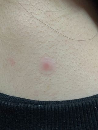 [큐어반H 스팟] 자외선 99프로 차단되는 스틱타입 스팟밴드(1팩 / 66매입) — 5점을 준 리뷰어가 2022년 12월 올린 사용 사진