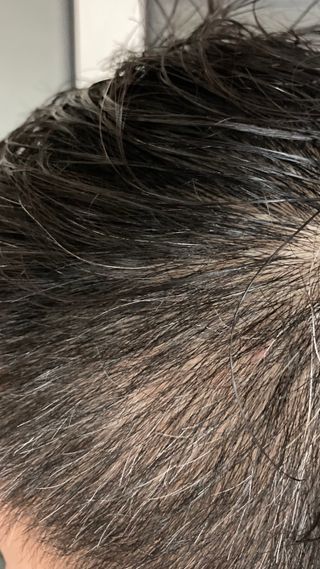 썸헤어 / SUMHAIR 썸헤어 써밋 안티 헤어로스 토닉 — 5점을 준 리뷰어가 2021년 6월 올린 사용 사진