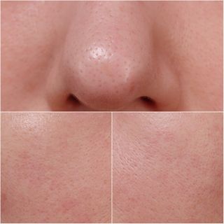 냉장고에 넣어요, 붉은 트러블 피부 다음날 진정되요 [버진팜스 푸딩수딩아토] — 4.5점을 준 리뷰어가 2021년 1월 올린 사용 사진