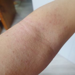 젠바이오 코스메틱스 젠바이오수딩크림]   가려운 피부 & 아토피 원픽 크림 — 5점을 준 리뷰어가 2022년 8월 올린 사용 사진