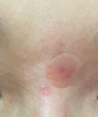 올리브영 엘라밴드 하이드로 도트 스팟패치 12mm, 티트리 — 5점을 준 리뷰어가 2022년 10월 올린 사용 사진