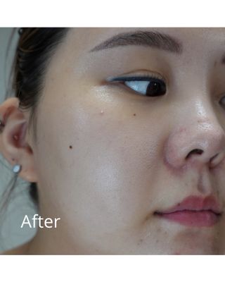 냉장고에 넣어요, 붉은 트러블 피부 다음날 진정되요 [버진팜스 푸딩수딩아토] — 5점을 준 리뷰어가 2021년 8월 올린 사용 사진