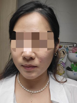 3M 넥스케어 블레미쉬 여드름패치 릴리프 111매(짜기 전 케어) +알코올스왑 증정 — 5점을 준 리뷰어가 2024년 5월 올린 사용 사진