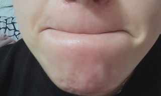 에버렐 아크네 클리어 패치 오리지널(40매) + XL(8매) 1세트, 각 1개씩 — 4점을 준 리뷰어가 2022년 5월 올린 사용 사진