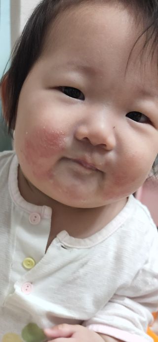 젠바이오 코스메틱스 젠바이오수딩크림]   가려운 피부 & 아토피 원픽 크림 — 5점을 준 리뷰어가 2022년 9월 올린 사용 사진