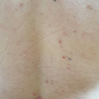 [후르디아] 등드름 잡는 바디 미스트 2개 세트 — 5점을 준 리뷰어가 2021년 7월 올린 사용 사진