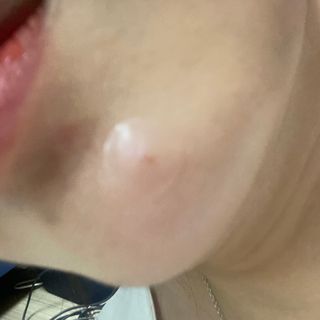 올리브영 엘라밴드 하이드로 도트 스팟패치 12mm, 티트리 — 5점을 준 리뷰어가 2022년 10월 올린 사용 사진