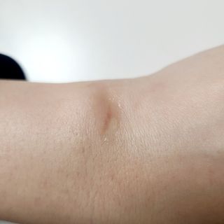 히루스카 포스트아크네 클리어 — 5점을 준 리뷰어가 2021년 3월 올린 사용 사진