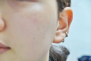 히루스카 포스트아크네 클리어 — 5점을 준 리뷰어가 2021년 2월 올린 사용 사진