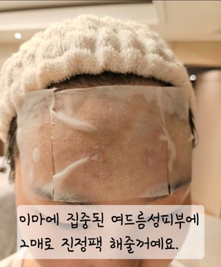 [후르디아] 화난피부 급속진정 AC 클리어 패드 (개별포장 50매) — 5점을 준 리뷰어가 2024년 4월 올린 사용 사진