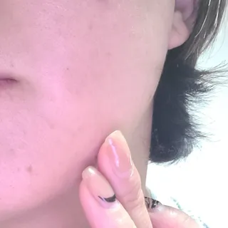 닥터플리너스 제트 큐어 크림 30ml + 제로 트러블 패치 9EA — 5점을 준 리뷰어가 2022년 3월 올린 사용 사진