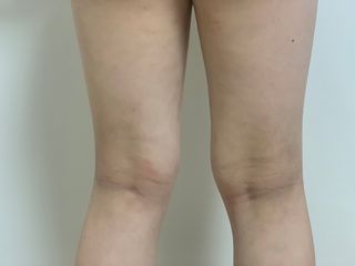 건선/아토/습진/민감성 피부 천연보습진정크림 소리온 크림 & 센시티브 크림 50g — 5점을 준 리뷰어가 2022년 1월 올린 사용 사진