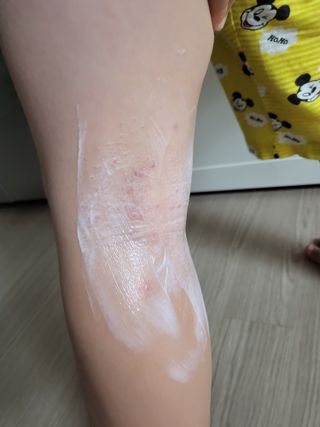 젠바이오 코스메틱스 젠바이오수딩크림]   가려운 피부 & 아토피 원픽 크림 — 5점을 준 리뷰어가 2022년 8월 올린 사용 사진