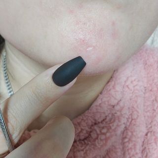 프리[에이앤에스] 올인원 피지제거기 15종 압출기 1세트 알콜솜 8매 증정 — 5점을 준 리뷰어가 2025년 1월 올린 사용 사진
