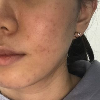 히루스카 포스트아크네 클리어 — 4점을 준 리뷰어가 2021년 1월 올린 사용 사진