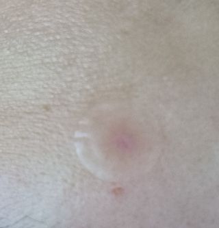 올리브영 엘라밴드 하이드로 도트 스팟패치 12mm, 티트리 — 5점을 준 리뷰어가 2022년 10월 올린 사용 사진