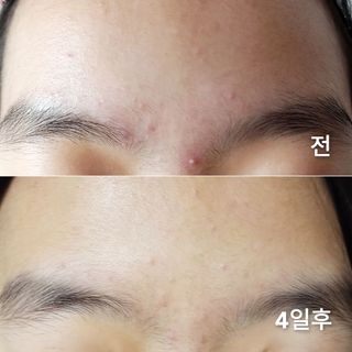 건선/아토/습진/민감성 피부 천연보습진정크림 소리온 크림 & 센시티브 크림 50g — 5점을 준 리뷰어가 2022년 1월 올린 사용 사진