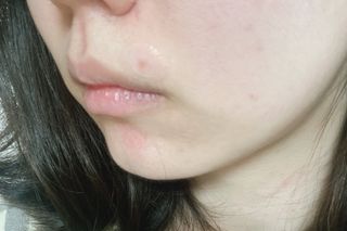 마이디플러스 트리플부스팅, 트러블 릴리프 케어 마이크로 패치 2종 중 택1 — 5점을 준 리뷰어가 2021년 11월 올린 사용 사진
