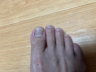 유케어 YOU CARE 문제성 손발톱케어_럭키풋 — 5점을 준 리뷰어가 2022년 9월 올린 사용 사진